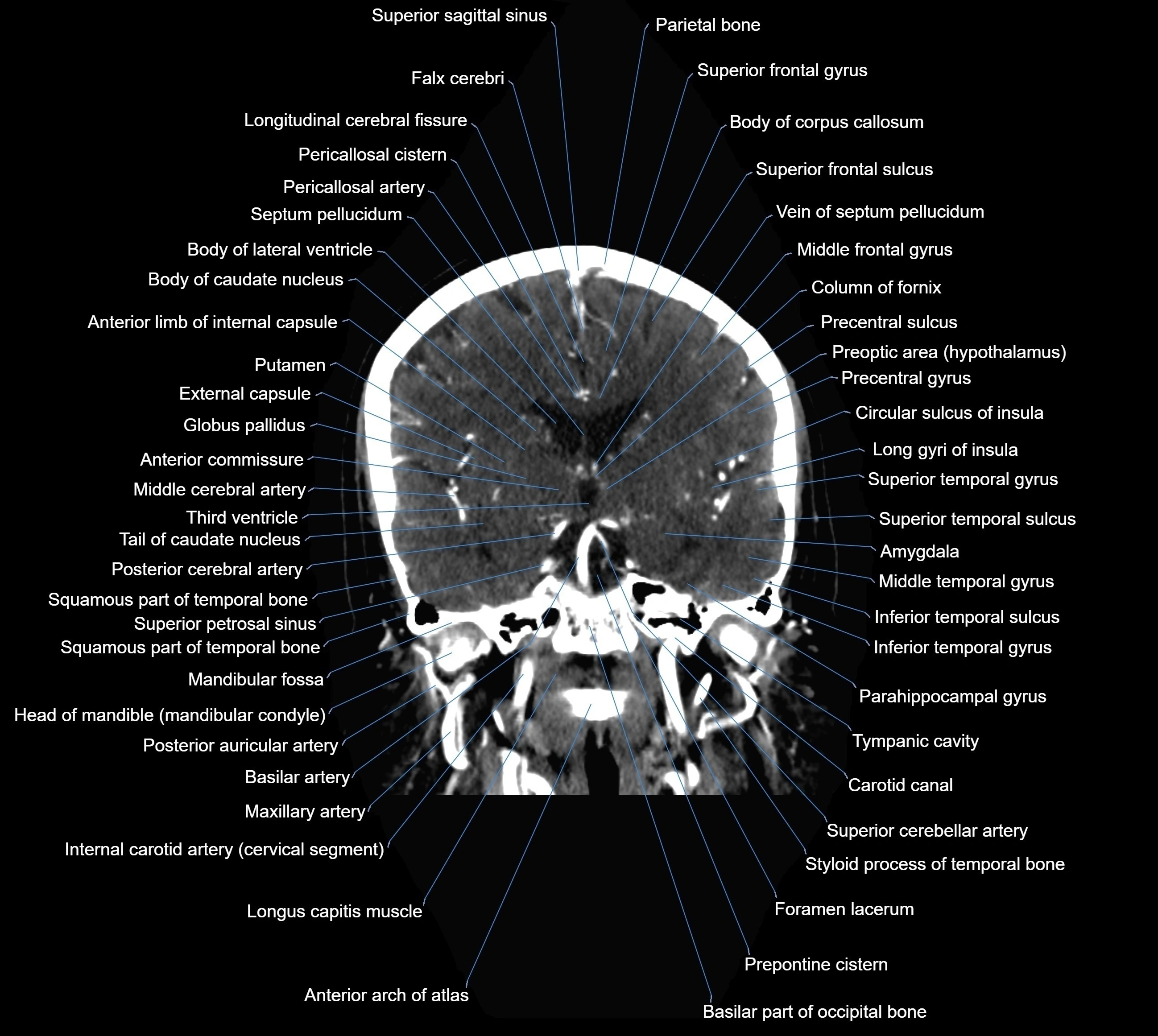 CT Brain coronal cross sectional radiology anatomy image  -img-00001-023.webp
